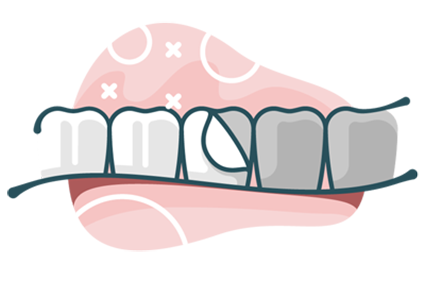 illustration of veneers