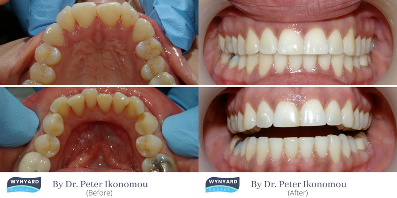 invisalign before and after 1