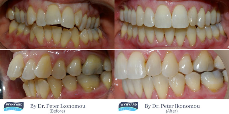 invisalign before and after 3