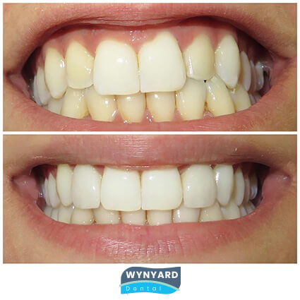 veneers before & after 8