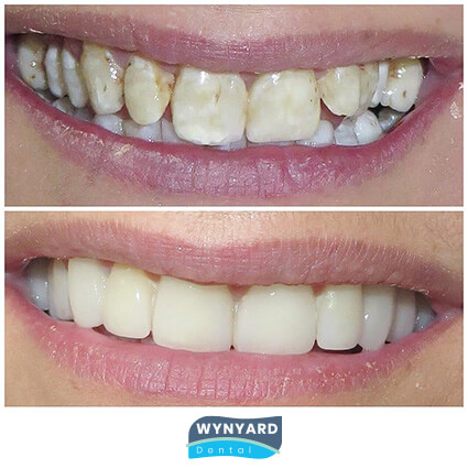 veneers before & after 7