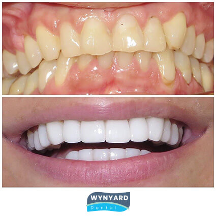 veneers before & after 6