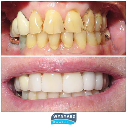 veneers before & after 5