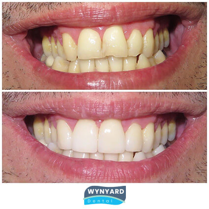 veneers before & after 3