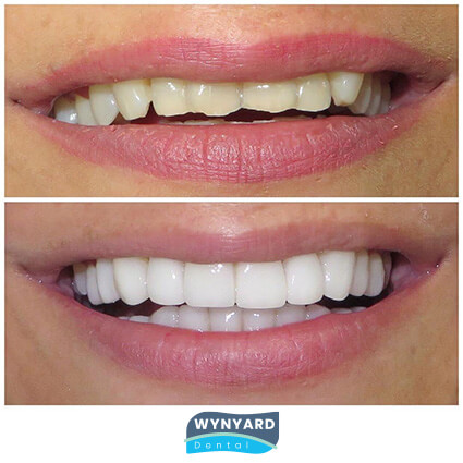 veneers before & after 4