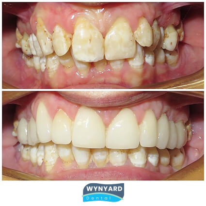 veneers before & after 2