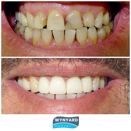 veneers before & after 1